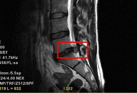 Mi a különbség a valódi porckorongsérv (Discus hernia) és a Schmorl-hernia között?
