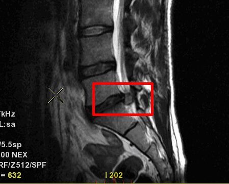 Mi a különbség a valódi porckorongsérv (Discus hernia) és a Schmorl-hernia között?